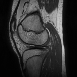 Anterior cruciate ligament tear - pediatric (Radiopaedia 62152-70260 Sagittal PD 118).jpg