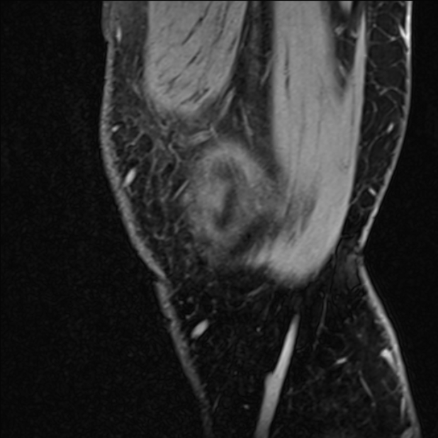 Anterior cruciate ligament tear - ramp lesion (Radiopaedia 71883-82322 Sagittal T1 vibe 130).jpg