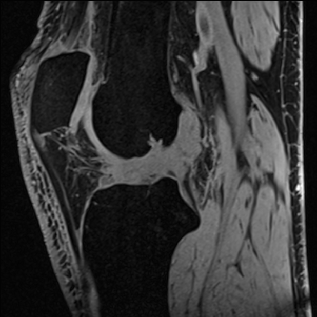 Anterior cruciate ligament tear - ramp lesion (Radiopaedia 71883-82322 Sagittal T1 vibe 70).jpg