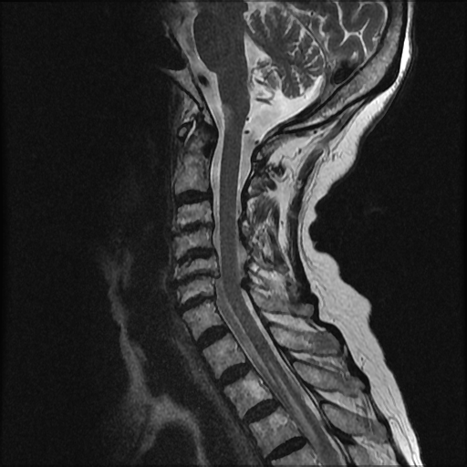 File:Anterior spinal artery syndrome (Radiopaedia 46335-50750 A 5).png
