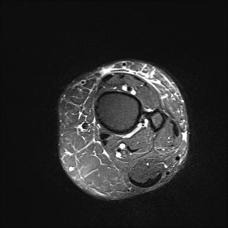 File:Anterior talofibular ligament injury - rupture with soft-tissue impingement (Radiopaedia 38765-40928 Axial T2 fat sat 1).jpg