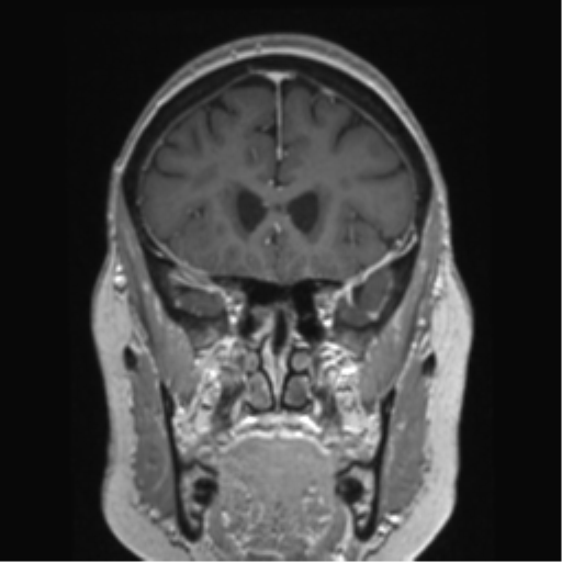 Anterior temporal pole cysts (Radiopaedia 46629-51102 Coronal T1 C+ 122).png