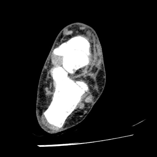 Anterior tibial artery false aneurysm (Radiopaedia 88984-105809 A 163).jpg