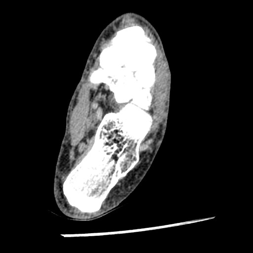 Anterior tibial artery false aneurysm (Radiopaedia 88984-105809 A 184).jpg