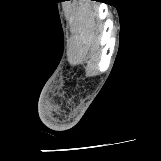 File:Anterior tibial artery false aneurysm (Radiopaedia 88984-105809 A 241).jpg
