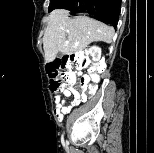 File:Aortic aneurysm and Lemmel syndrome (Radiopaedia 86499-102554 D 19).jpg
