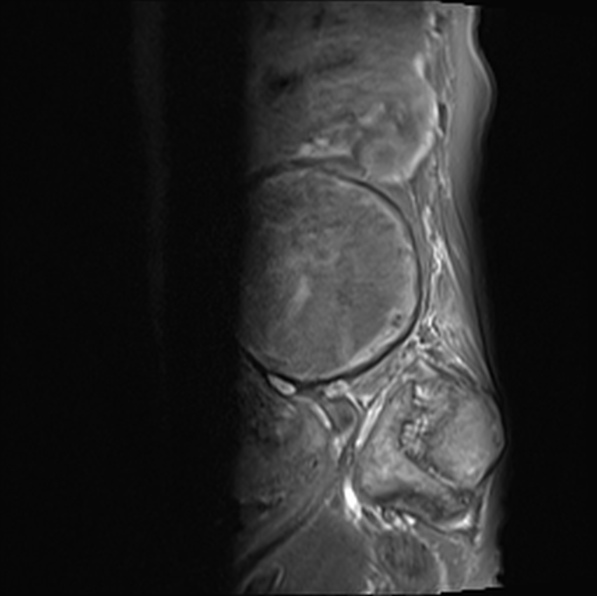 File:Aortic aneurysm with spinal destruction (Radiopaedia 42301-45409 Sagittal T1 fat sat 14).jpg