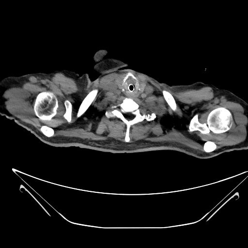 Aortic arch aneurysm (Radiopaedia 84109-99365 Axial non-contrast 10).jpg