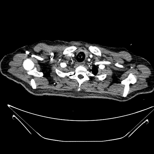 Aortic arch aneurysm (Radiopaedia 84109-99365 B 63).jpg