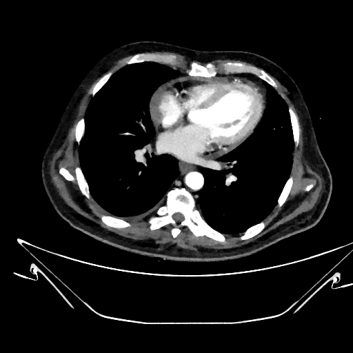 Aortic arch aneurysm (Radiopaedia 84109-99365 C 274).jpg