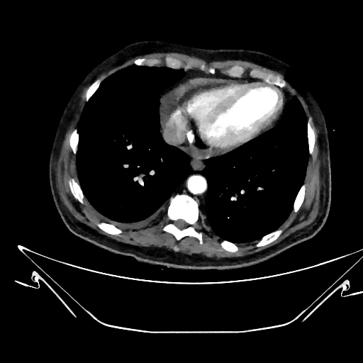 Aortic arch aneurysm (Radiopaedia 84109-99365 C 353).jpg
