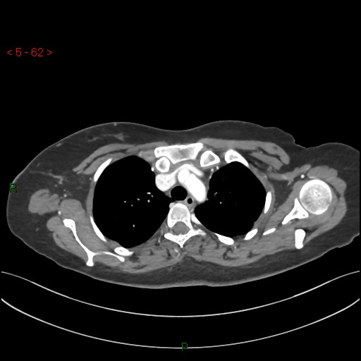 Aortic arch origin of left vertebral artery (Radiopaedia 51520-57286 A 61).jpg