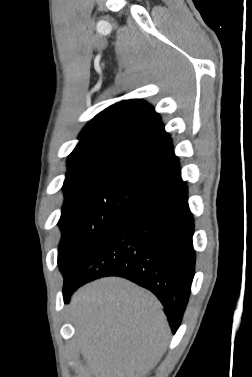 Aortic coarctation with aneurysm (Radiopaedia 74818-85828 B 27).jpg