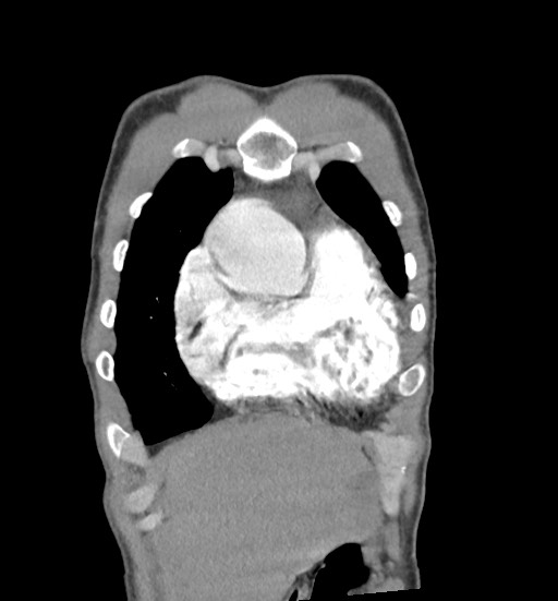 File:Aortic coarctation with aneurysm (Radiopaedia 74818-85828 C 19).jpg