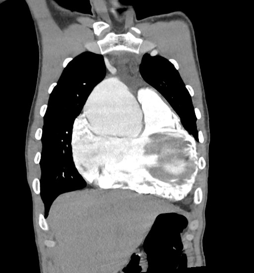 Aortic coarctation with aneurysm (Radiopaedia 74818-85828 C 28).jpg