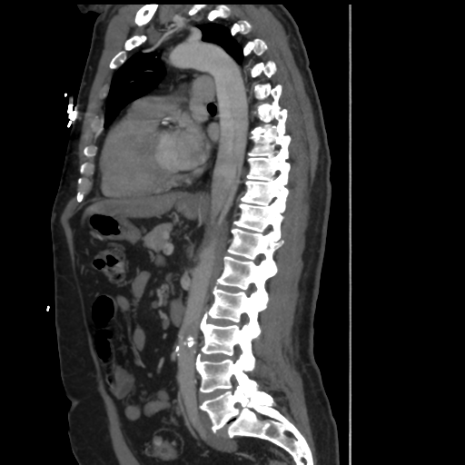 File:Aortic dissection- Stanford A (Radiopaedia 37759-39664 Sagittal C+ delayed 22).png