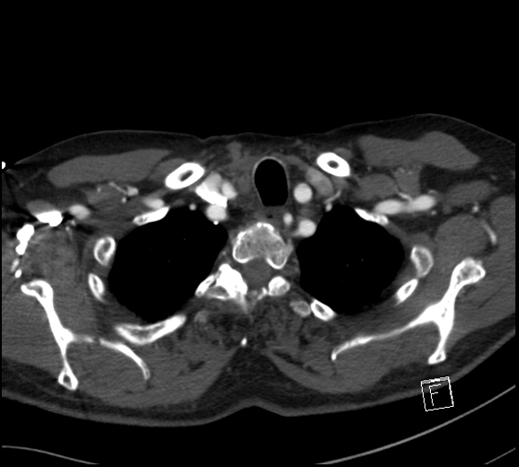 Aortic dissection (CTPA) (Radiopaedia 75506-86750 A 11).jpg