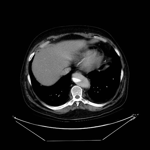 Aortic dissection (Radiopaedia 62562-71000 A 37).jpg