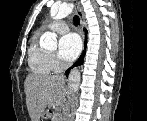 File:Aortic dissection - Stanford A -DeBakey I (Radiopaedia 28339-28587 C 26).jpg