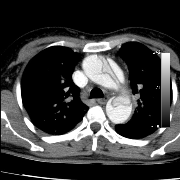 Aortic dissection - Stanford type A (Radiopaedia 29247-29659 A 26).jpg