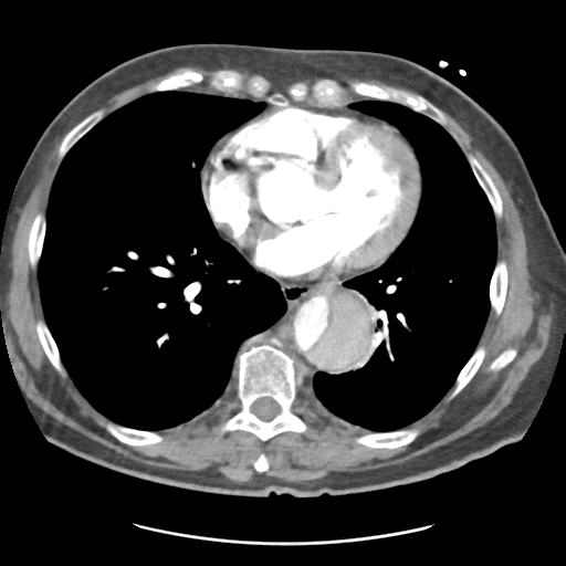 Aortic dissection - Stanford type B (Radiopaedia 50171-55512 A 32).png