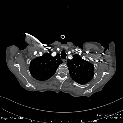File:Aortic dissection with extension into aortic arch branches (Radiopaedia 64402-73204 B 86).jpg