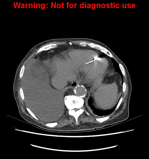 Aortic graft infection (Radiopaedia 44979-48907 Axial non-contrast 18).jpg