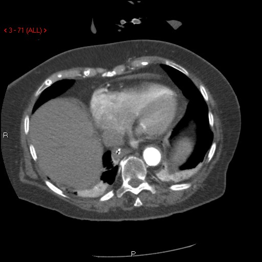 Aortic intramural hematoma (Radiopaedia 27746-28001 A 71).jpg