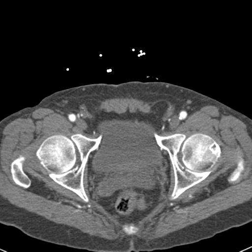 Aortic intramural hematoma (Radiopaedia 31139-31838 B 164).jpg