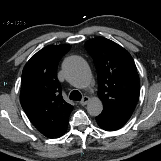 Aortic intramural hematoma (Radiopaedia 48463-53380 Axial non-contrast 54).jpg