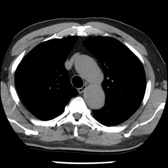 Aortic intramural hematoma (type B) (Radiopaedia 79323-92387 Axial non-contrast 14).jpg