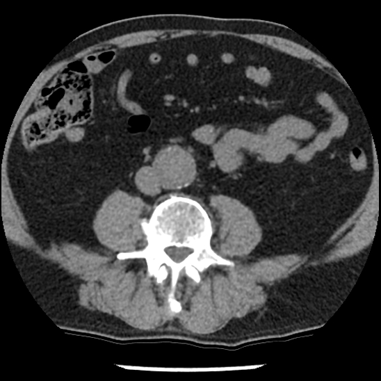 Aortic intramural hematoma (type B) (Radiopaedia 79323-92387 Axial non-contrast 80).jpg