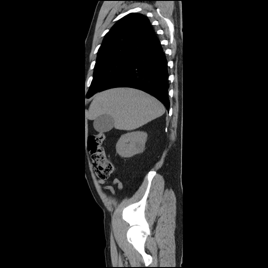 Aortic intramural hematoma (type B) (Radiopaedia 79323-92387 G 5).jpg