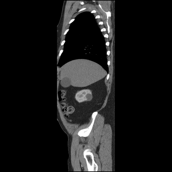 Aortic intramural hematoma (type B) (Radiopaedia 79323-92387 H 3).jpg