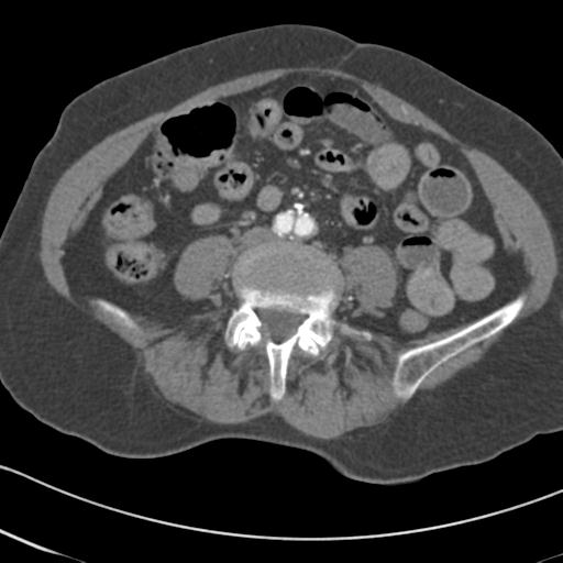 File:Aortic intramural hematoma from penetrating atherosclerotic ulcer (Radiopaedia 31137-31836 A 126).jpg