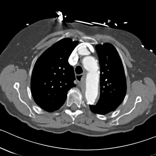 Aortic intramural hematoma from penetrating atherosclerotic ulcer (Radiopaedia 31137-31836 A 22).jpg