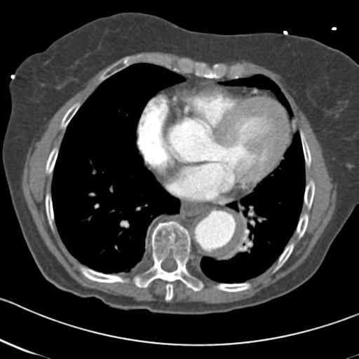 Aortic intramural hematoma from penetrating atherosclerotic ulcer (Radiopaedia 31137-31836 A 53).jpg