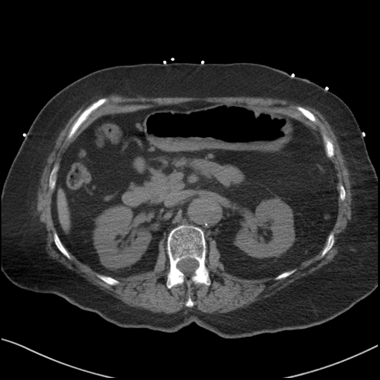 Aortic intramural hematoma with dissection and intramural blood pool (Radiopaedia 77373-89491 Axial non-contrast 110).jpg