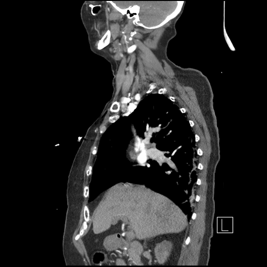 File:Aortic intramural hematoma with dissection and intramural blood pool (Radiopaedia 77373-89491 D 30).jpg