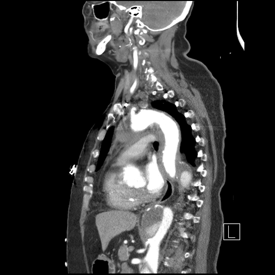 Aortic intramural hematoma with dissection and intramural blood pool (Radiopaedia 77373-89491 D 50).jpg