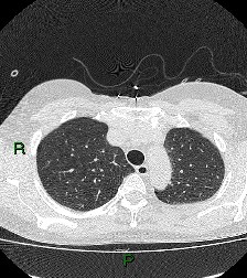 File:Aortic valve endocarditis (Radiopaedia 87209-103485 Axial lung window 27).jpg