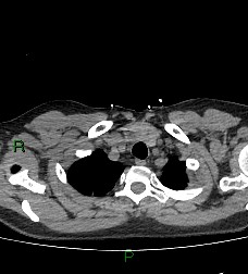 Aortic valve endocarditis (Radiopaedia 87209-103485 Axial non-contrast 16).jpg
