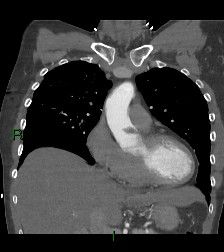 Aortic valve endocarditis (Radiopaedia 87209-103485 D 45).jpg