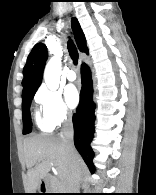 Aortic valve non-coronary cusp thrombus (Radiopaedia 55661-62189 D 30).png
