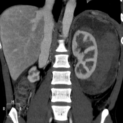 File:Aorto-left renal vein fistula (Radiopaedia 45534-49628 B 42).jpg