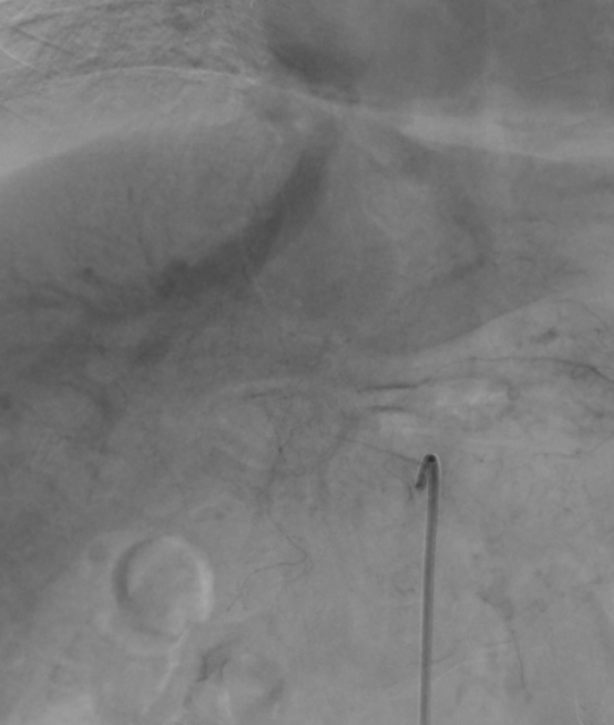 Aorto portal shunt (Radiopaedia 69573-79586 Frontal Celiac axis 68).jpg