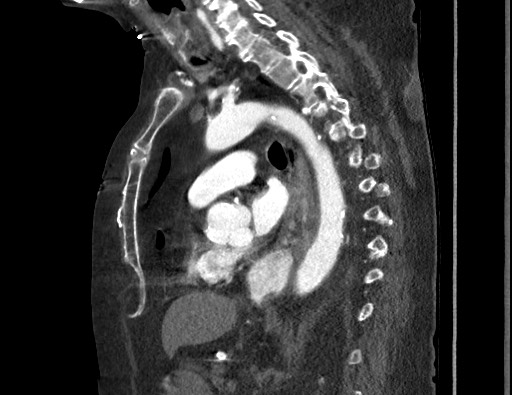 Aortoesophageal fistula with endovascular repair (Radiopaedia 73781-84592 Sagittal C+ CTPA 110).jpg