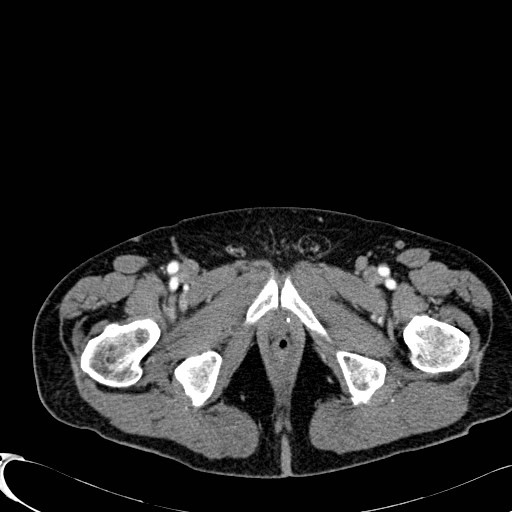 File:Appendiceal adenocarcinoma complicated by retroperitoneal abscess (Radiopaedia 58007-65039 B 149).jpg