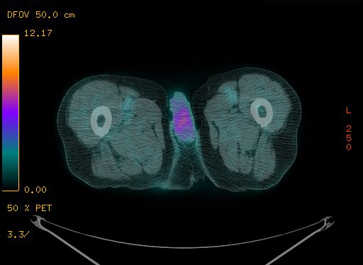 File:Appendiceal adenocarcinoma complicated by retroperitoneal abscess (Radiopaedia 58007-65041 Axial PET-CT 215).jpg