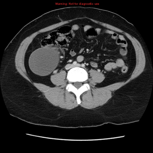 File:Appendiceal mucinous cystadenoma (Radiopaedia 8263-9111 Axial liver window 50).jpg
